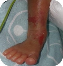 Tema 14.1. Atención de Enfermería en el Recién Nacido Sano